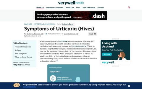 Urticaria (Hives): Signs, Symptoms, and Complications